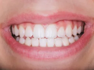pacjenta z uśmiechem posiadająca licówki na zęby